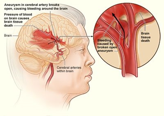 Spontaneous Aneurysmal Subarachnoid Hemorrhage {faces}